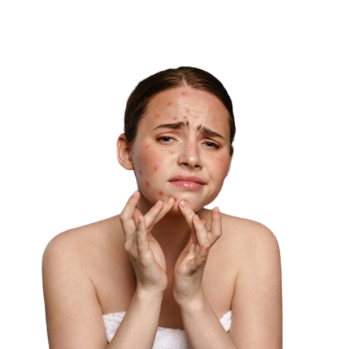 Acne/ Acne Scars