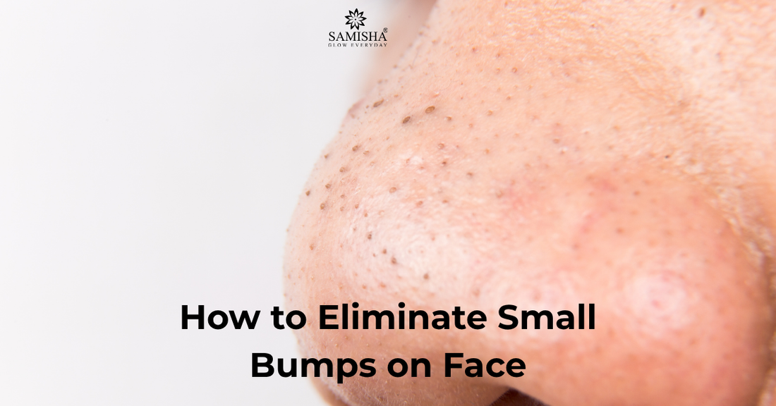 How to Get Rid of Blackheads on Nose