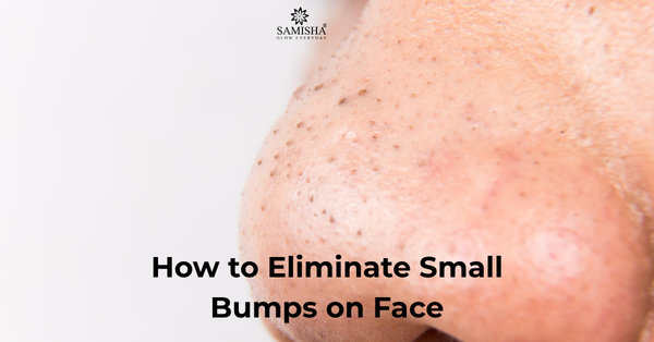 How to Get Rid of Blackheads on Nose