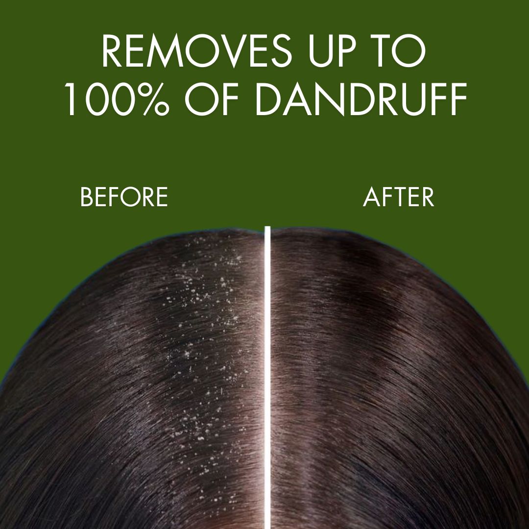 Dandruff Spray | Fights Severe Dandruff | Prevents Flaky Scalp | Non Greasy Non Oily